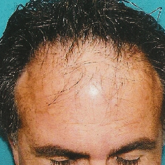 45-54 year old man treated with Hair Transplant before 3495102