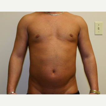 35-44 year old man treated with Vaser Liposuction before 2083534