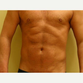 35-44 year old man treated with Vaser Liposuction after 2083534