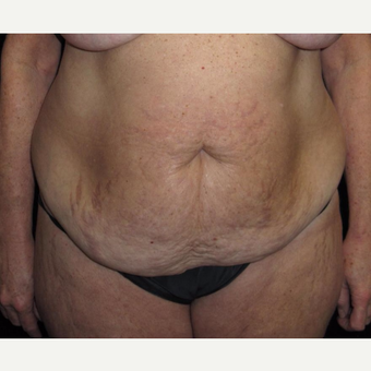 57 year old woman treated with Tummy Tuck before 3092858