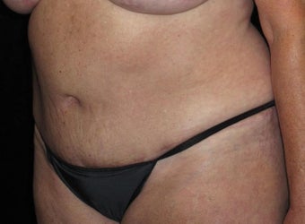 57 year old woman treated with Tummy Tuck 3092858