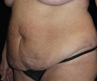 57 year old woman treated with Tummy Tuck 3092858