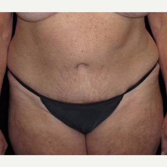 57 year old woman treated with Tummy Tuck after 3092858