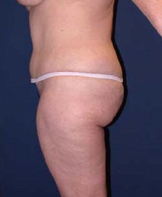 35-44 year old woman treated with SAFELipo 3126365