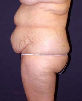35-44 year old woman treated with SAFELipo 3126365