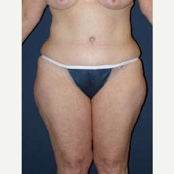 35-44 year old woman treated with SAFELipo after 3126365