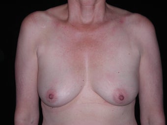 60 year old lady treated for saggy breasts. before 1519424