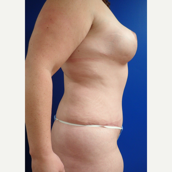 35-44 year old woman treated with Mommy Makeover after 3322454