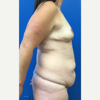 35-44 year old woman treated with Mommy Makeover before 3322454