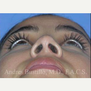 29 year old woman treated with Revision Rhinoplasty after 3460657