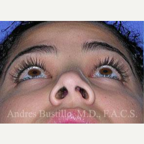 29 year old woman treated with Revision Rhinoplasty before 3460657