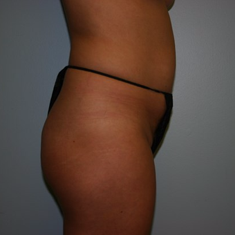 Brazilian Butt Lift before 3667431