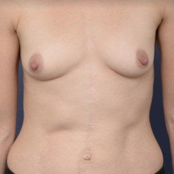 33 year old woman treated with Breast Augmentation before 3670142
