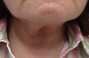 Woman treated with Pelleve before 2112714