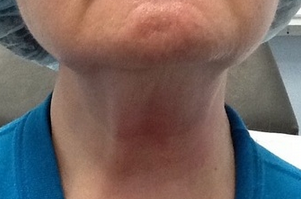 Woman treated with Pelleve after 2112714