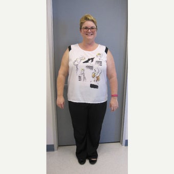 45-54 year old woman treated with Sleeve Gastrectomy after 1955880
