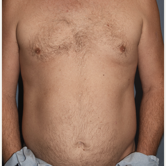 45-54 year old man treated with Liposculpture for Abdominal Etching before 3407855