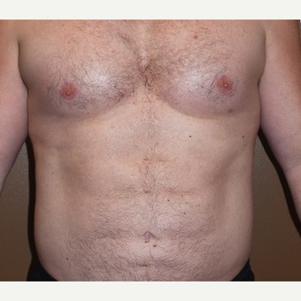 45-54 year old man treated with Liposculpture for Abdominal Etching after 3407855