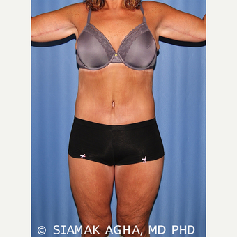35-44 year old woman treated with Body Lift after 2748773