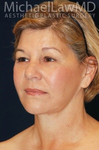 55-64 year old woman treated for SMAS Facelift after 1534792