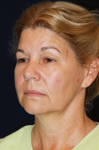 55-64 year old woman treated for SMAS Facelift before 1534792