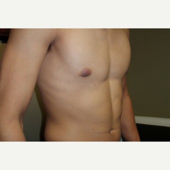 18-24 year old man treated with Male Breast Reduction 1591637
