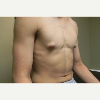 18-24 year old man treated with Male Breast Reduction 1591637
