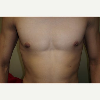 18-24 year old man treated with Male Breast Reduction after 1591637