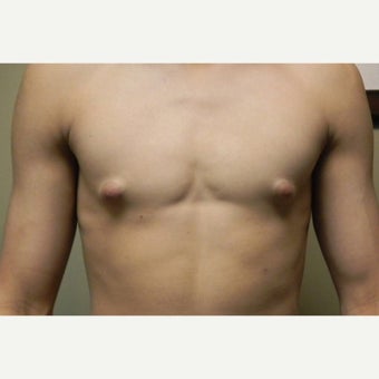 18-24 year old man treated with Male Breast Reduction before 1591637