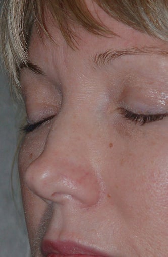 Non-Surgical Rhinoplasty before 182607