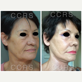 Complete facial rejuvenation of a 61 year old female before 3031245