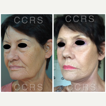 Complete facial rejuvenation of a 61 year old female after 3031245