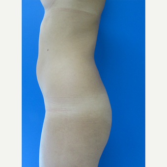18-24 year old woman treated with Brazilian Butt Lift before 3107908