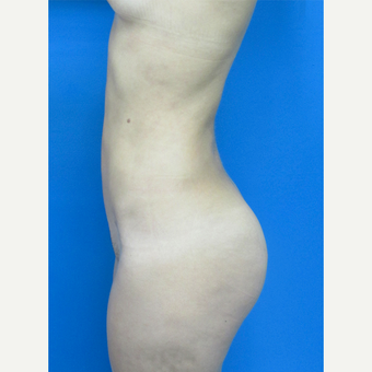 18-24 year old woman treated with Brazilian Butt Lift after 3107908