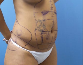 35-44 year old woman treated with Smart Lipo before 3098028