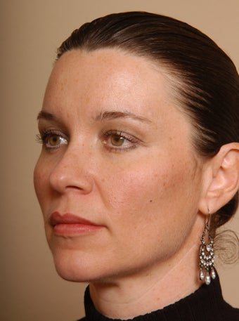 Fat Injections to Cheek & Cheekbone Area, Jawline, Brow & Lips, Botox to Brow. after 252924