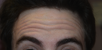 32 Year Old Male Treated For Forehead Lines before 1373421