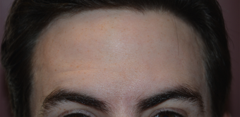 32 Year Old Male Treated For Forehead Lines after 1373421