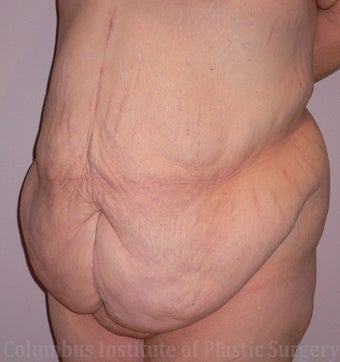 38 Year Old Woman has Tummy Tuck before 1236401