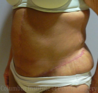 38 Year Old Woman has Tummy Tuck after 1236401