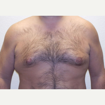 38 year old man treated with Liposuction before 3683771