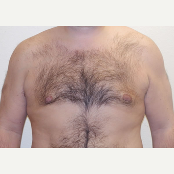 38 year old man treated with Liposuction after 3683771