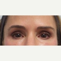 45-54 year old woman treated with Restylane around the eye and tear trough after 2377938