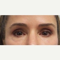 45-54 year old woman treated with Restylane around the eye and tear trough before 2377938