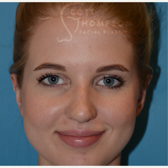 18-24 year old woman treated with Ear Surgery after 3321003