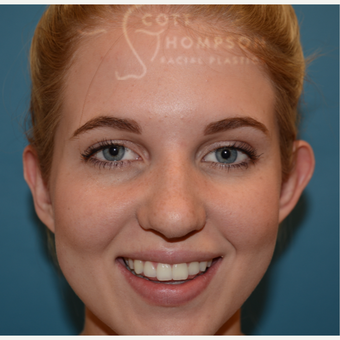 18-24 year old woman treated with Ear Surgery before 3321003