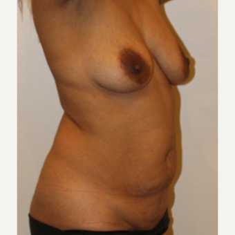 45-54 year old woman treated with Mommy Makeover before 3372612