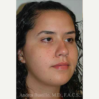 16 year old woman treated with Rhinoplasty before 3462309