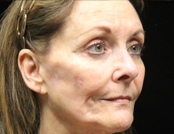 65-74 year old woman treated with Liquid Facelift 3502977