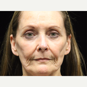 65-74 year old woman treated with Liquid Facelift before 3502977